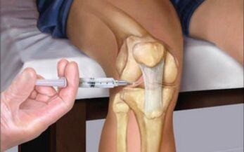 injection intra-articulaire dans l'articulation pour l'arthrose