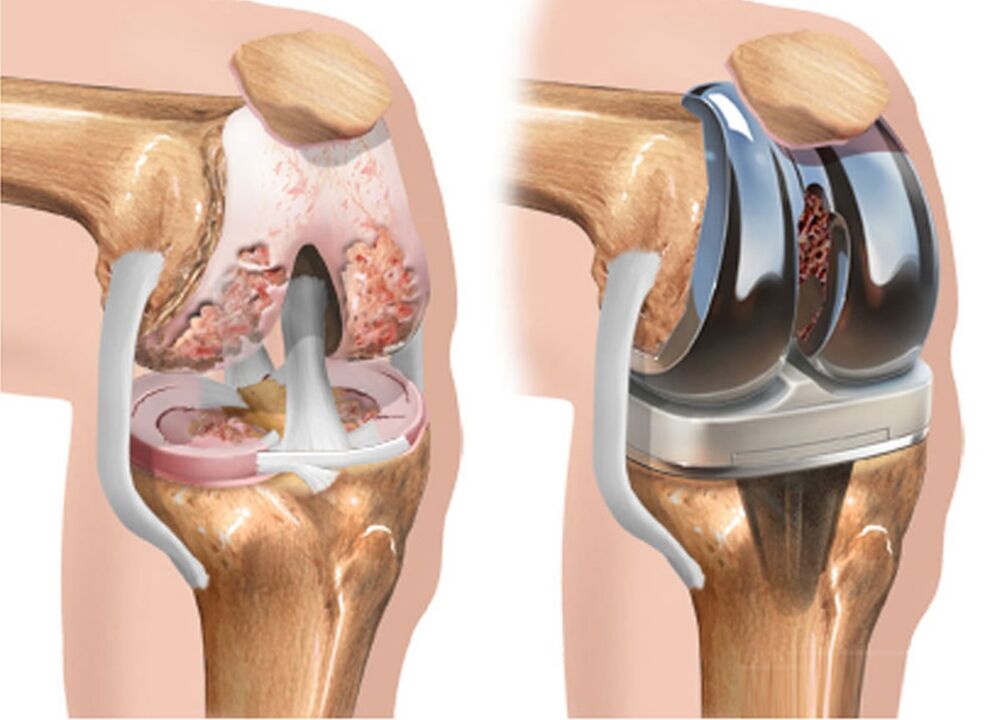 avant et après arthrose du genou pour arthrose