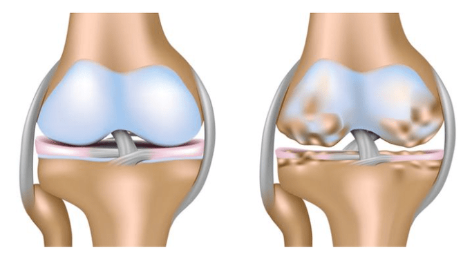 cartilage sain et dommages à l'articulation du genou avec arthrose