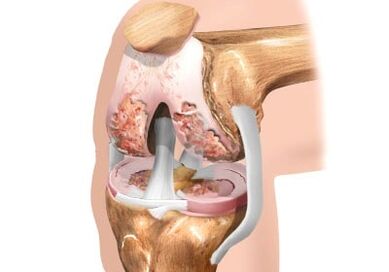 Endommager l'arthrose de l'articulation du genou
